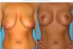 Dr. McClure - Breast Lift with Implants