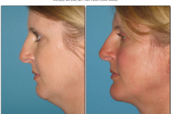 Chin-Implant.002