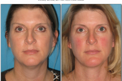 Chin-Implant.003