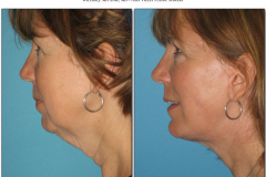 Chin-Implant.005