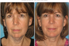 Chin-Implant.006
