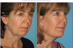 Chin-Implant.007