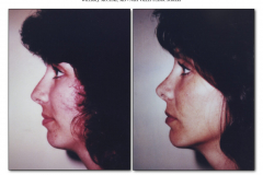 Chin-Implant.008