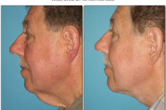 NeckLift.006