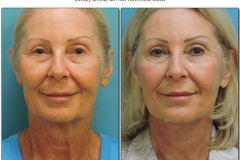 Facelift-1