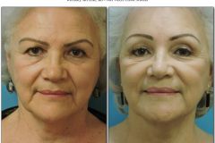Facelift-5