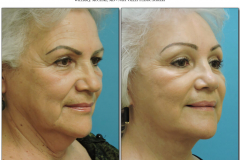 Facelift-6