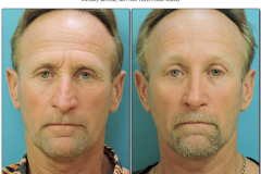 Facelift-male.002