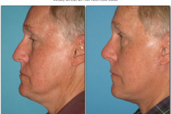 Facelift-male.010