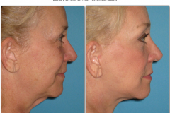 Facelift.095