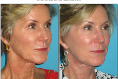 Facelift.100