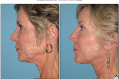Facelift.101