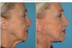 Facelift.104
