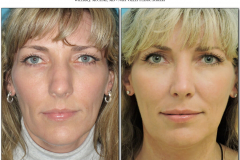 Rhinoplasty.003