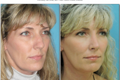 Rhinoplasty.004