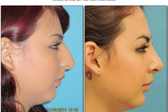 Rhinoplasty.005