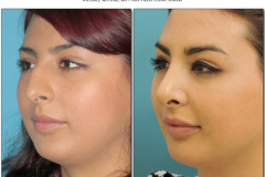 Rhinoplasty.007