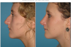Rhinoplasty.008