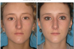 Rhinoplasty.009