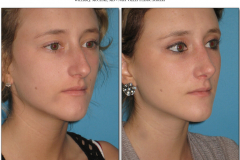 Rhinoplasty.010