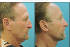 Rhinoplasty.011