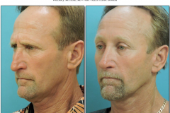 Rhinoplasty.013
