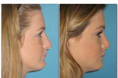 Rhinoplasty.014