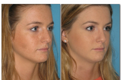 Rhinoplasty.016