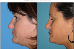 Rhinoplasty.017