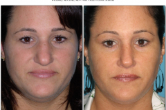 Rhinoplasty.018