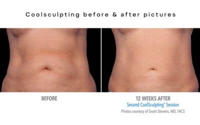 Are You Considering CoolSculpting?
