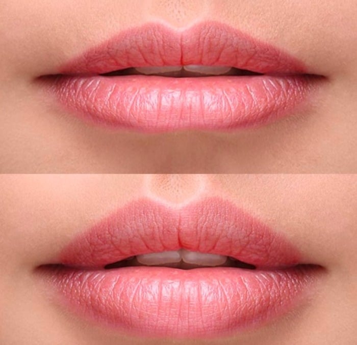Lips-fillers-Juvederm
