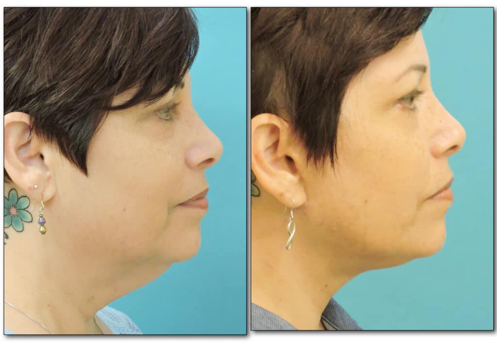 neck-liposuction-2