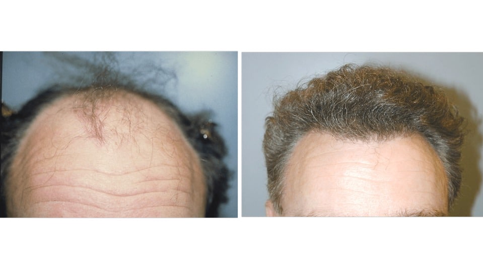 neograft-hair-restoration-1