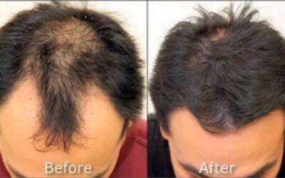 Frequently Asked Questions About Hair Restoration