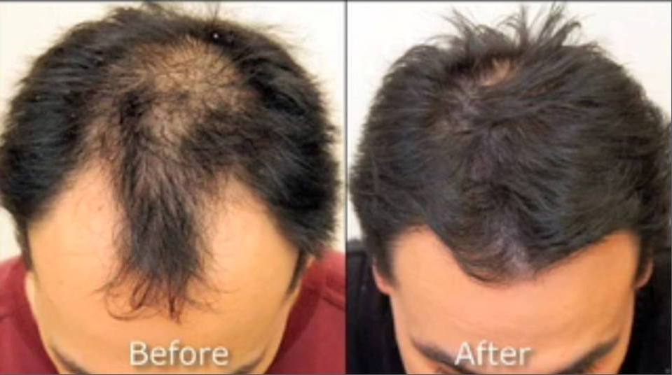 Hair Transplant Mcallen Tx