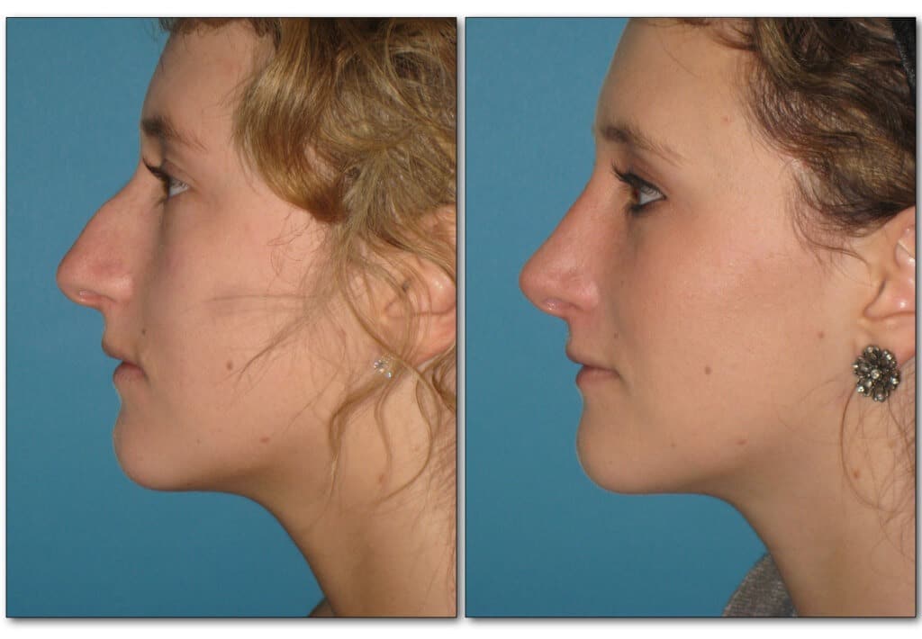 rhinoplasty-nose-job-plastic-surgery-2