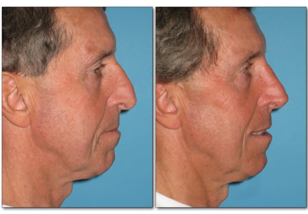 rhinoplasty-nose-job-plastic-surgery-3