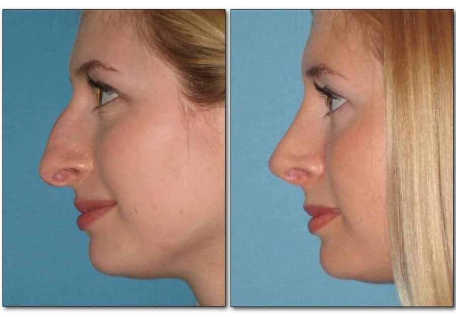 rhinoplasty-nose-job-plastic-surgery-4