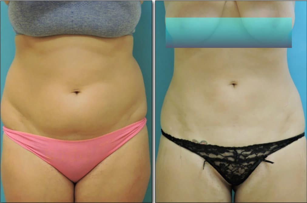 Liposuction banner-1