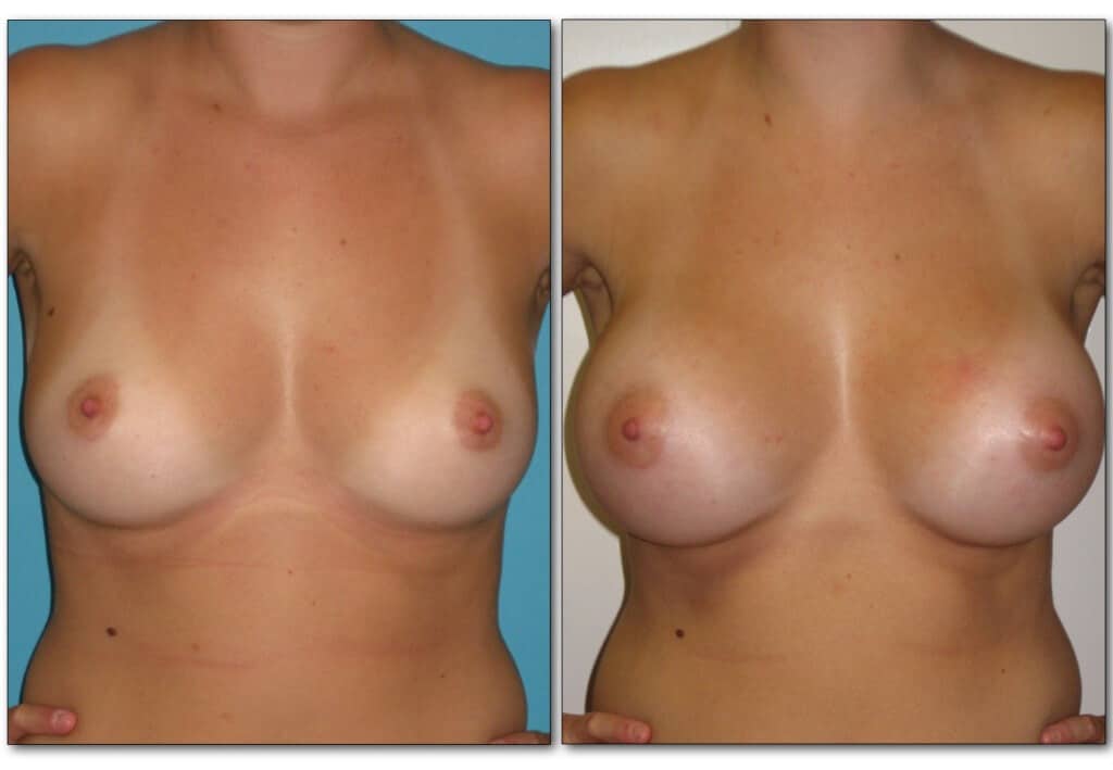 breast-augmentation-plastic-surgery-1