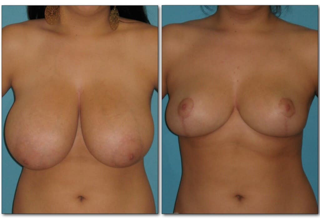 breast-reduction 1