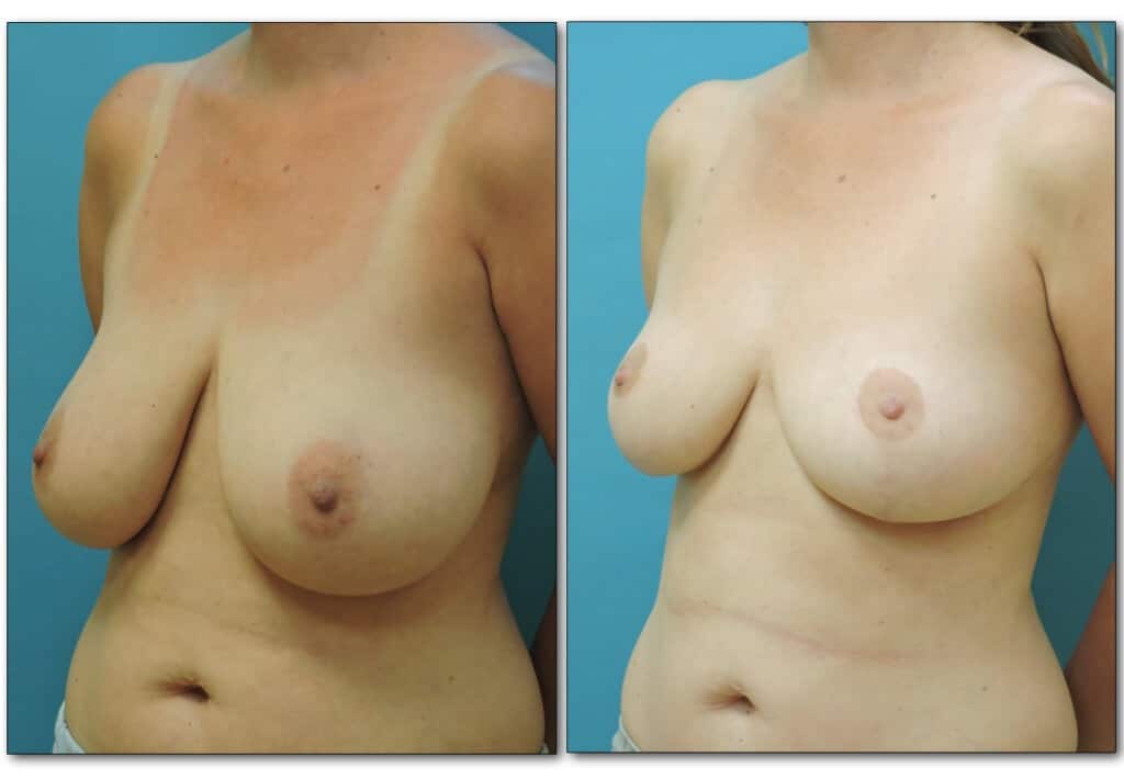 breast-reduction 2