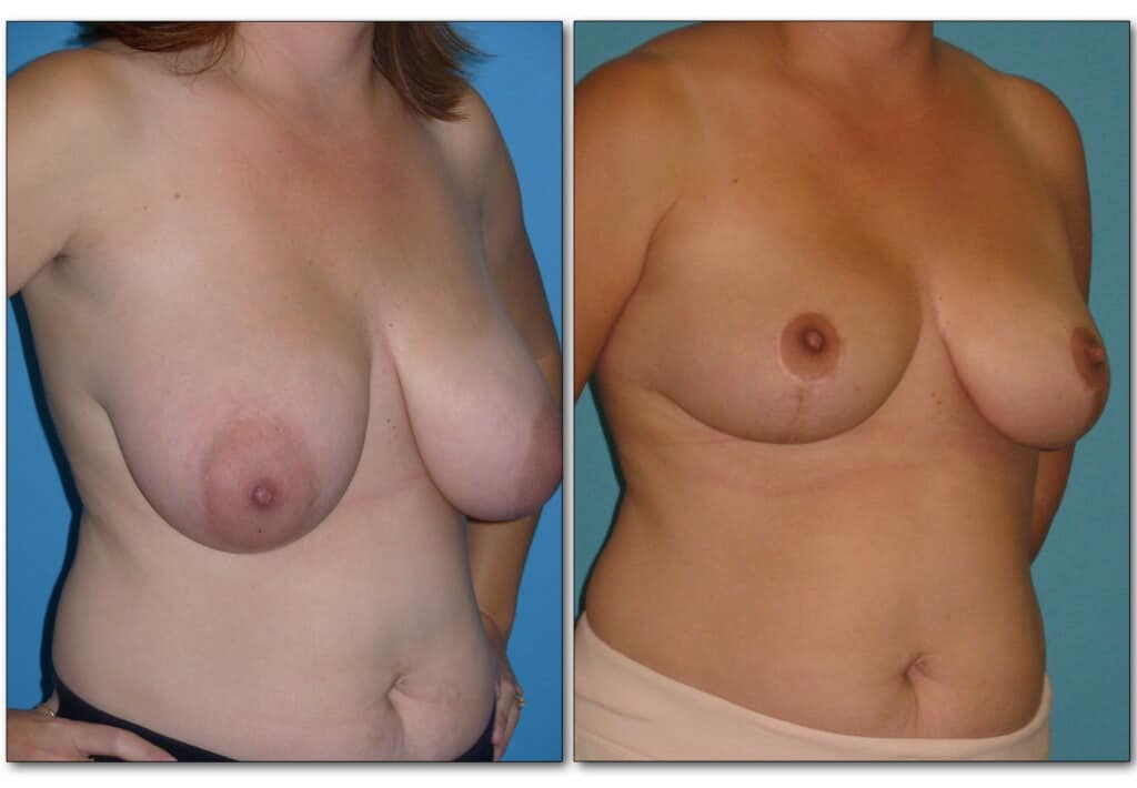 breast-reduction 3