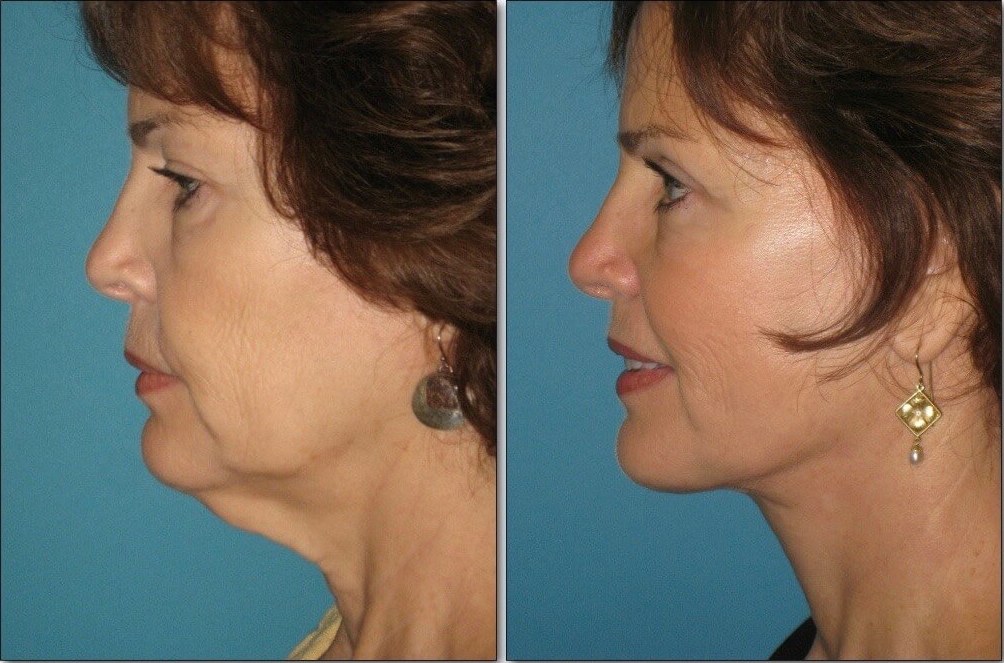 face-procedure-plastic-surgery-1 copy