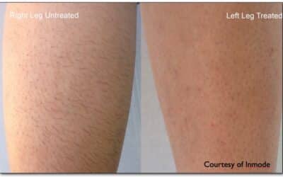 6 Facts About Laser Hair Removal