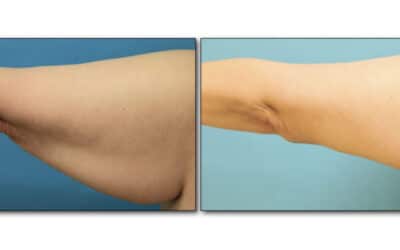 Is an Arm Lift (Brachioplasty) Right For You?