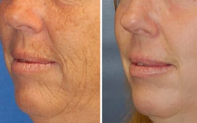 What is Erbium laser resurfacing?