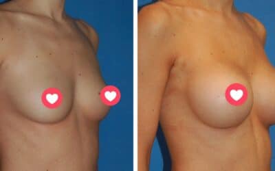 The latest in Breast Augmentation