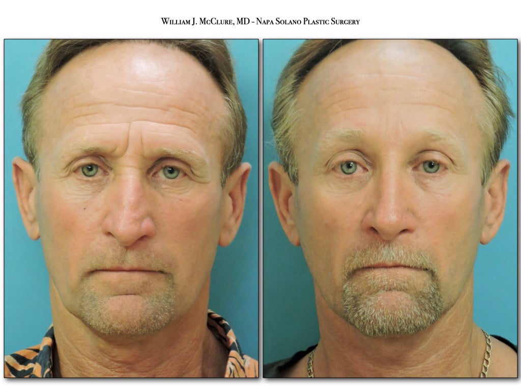 11-20-facial-rejuvenation-for-men3